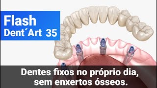 Flash Dent’Art - Episódio 35 - Dentes fixos no próprio dia, sem enxertos ósseos 🤩