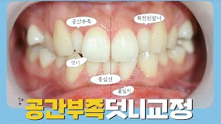 공간부족 앞니덧니 중심선 불일치 부분반대교합 발치교정