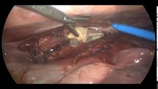 Minimally Invasive Esophagectomy with the Transoral EEA Stapler: Part II