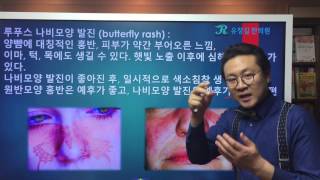 루푸스(Lupus) 나비모양의 발진(butterfly rash)