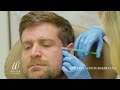 male botox® treatment from start to finish weiler plastic surgery