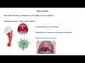 infectious mononucleosis imn glandular fever causes signs u0026 symptoms diagnosis u0026 treatment