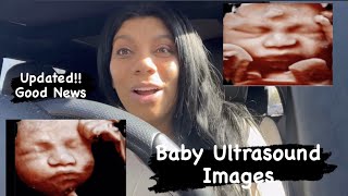 Update on breech baby!! ULTRASOUND IMAGES OF OUR BEAUTIFUL BOY.