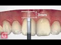 HOW TO Use #Dental Bone Sounding Gauge BEFORE #Gingivectomy