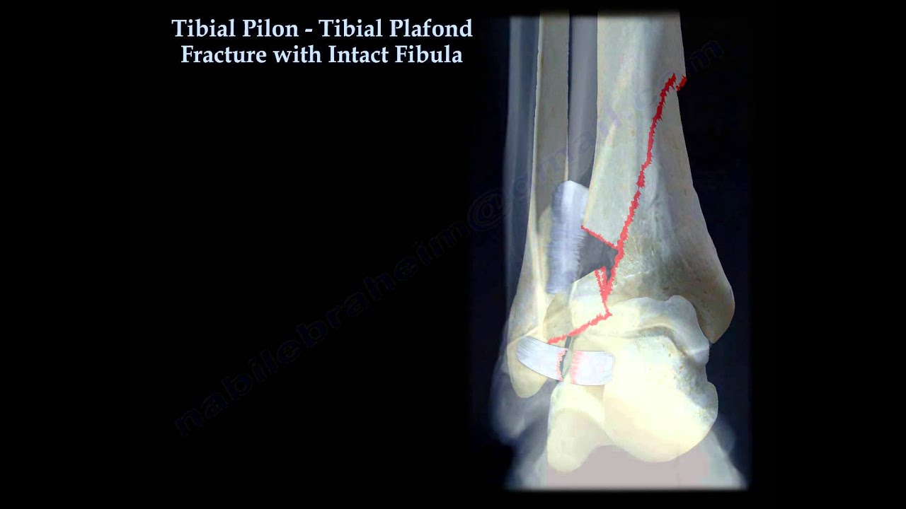 Tibial Pilon Fracture With Intact Fibula - Everything You Need To Know ...