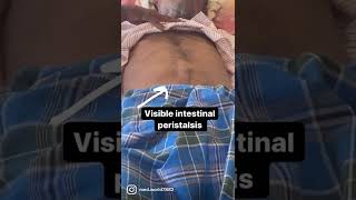 VIP - visible intestinal peristalsis #neetug #next  #trending #surgery #acsrgmc #mbbs