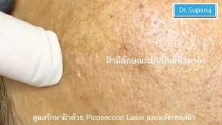 ดูแลรักษาฝ้าด้วย Picosecond Laser และการผลัดเซลล์ผิว Chemical Peeling