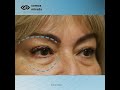 Blefaroplastia superior e inferior con láser de CO2 - Dr Martin Devoto