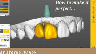 How to do the perfect teeth in EXOCAD