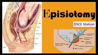 Episiotomy : Types, Procedure, Indications and Complications