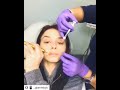 Lip Fillers by Dr. Caroline Chang, Board Certified Dermatologist