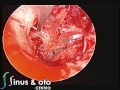 endoscopic tympanoplasty