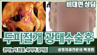 (SUB) 두피절개 광대수술 후 관자놀이 함몰, 하방변위, 와이어고정 끊어짐 [비대면상담 #173] / Temple depression after cheekbone surgery