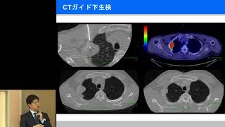 【第21回　希少がん Meet the Expert：悪性胸膜中皮腫】講演　後藤 悌【国立がん研究センター希少がんセンター】