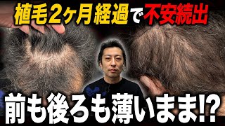 【植毛2ヶ月】生え際と後頭部が薄すぎる!?これがリアルな状態です。