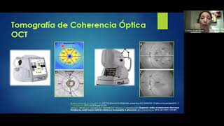 Oct de Nervio Óptico Mácula en Glaucoma