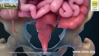 Rectum Removal – CIMS Hospital