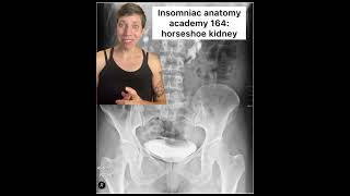 Insomniac anatomy academy 164: horseshoe kidneys #science #anatomy #sciencefacts #bodies #medicine