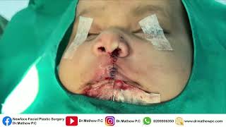 Cleft Cutie undergoing a beautiful transformation