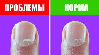 Полоски и белые пятна на ногтях: что это говорит о вашем здоровье?