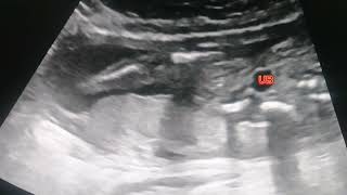 Visulizing Fetal lower limbs