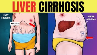 Liver cirrhosis - Warning Signs 🔥 Don't ignore these Red Flags | Chronic Liver Disease | Fatty Liver
