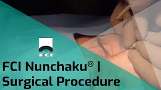 FCI Nunchaku® | Self-retaining bicanalicular nasolacrimal intubation | FCI Lacrimal