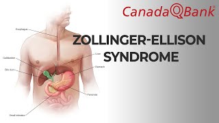 Zollinger-Ellison syndrome