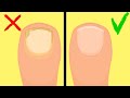 How to Get Rid of Toenail Fungus- Proven Natural Home Remedies for Fast Results.