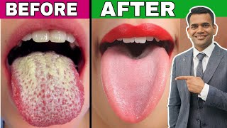#1 Best way to treat candida and yeast overgrowth for good
