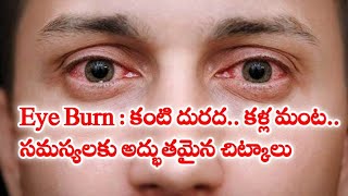 Eye Burn || కంటి దుర‌ద‌.. క‌ళ్ల మంట‌.. స‌మ‌స్య‌ల‌కు అద్భుత‌మైన చిట్కాలు..!