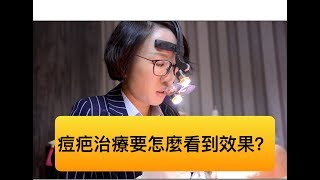 嚴重型痘疤的痘疤治療要如何才能看到效果？