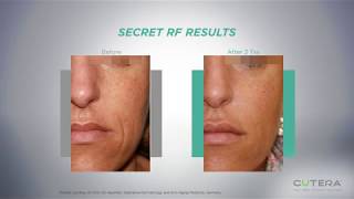 Secret RF Micro Needling is finally available in Palm Beach