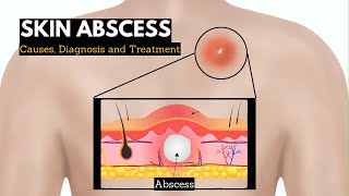 Skin Abscess, Causes, Signs and Symptoms, Diagnosis and Treatment.