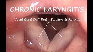 Laryngology : Chronic Laryngitis