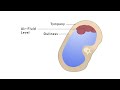 ascites shifting dullness clinical examination