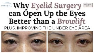 How Asian Double Eyelid Surgery can Open up the Eyes More Naturally than a Brow Lift