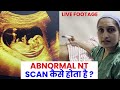 Abnormal NT Scan | Nuchal translucency (NT) scan | Live demo -Dr Asha Gavade