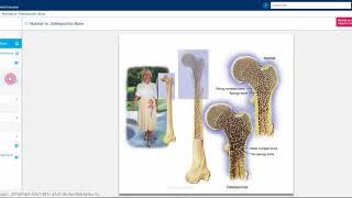 iMD in Action: Using iMD to Educate an Osteoporosis Patient