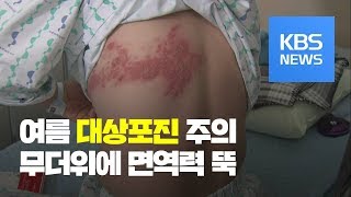 본격 무더위에 면역력 ‘뚝’…대상포진 주의! / KBS뉴스(News)