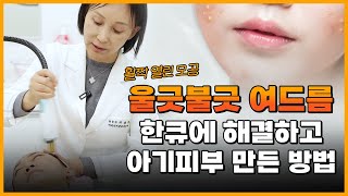 여드름, 모공 한번에 해결하고 아기 피부 만든 방법은?