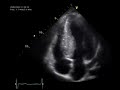 systolic anterior motion sam of the mitral valve in hcmp.