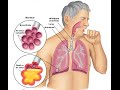 Bacterial Pneumonia: Symptoms & Treatment Bacterial Pneumonia: Symptoms & Treatment