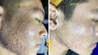 Acne Treatment For \