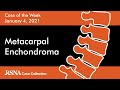 Case of the Week: Metacarpal Enchondroma