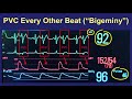 PVCs Symptoms and Treatment - in Plain English!