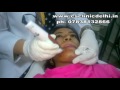 acne scars open pores treatment with dermapen dr chetna singh