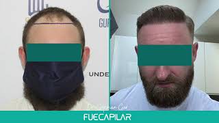 FUE Hair Transplant (2688 Grafts NW III - IIIa) by Dr Gokhan Gür - FUECAPILAR, Istanbul, Turkey