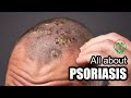 தலையில் சொரியாசிஸ் பிரச்சினையா அல்லது பொடுகா ? I PSORIASIS discussion I CASE STUDY I Selvin Clinic