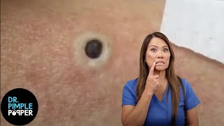 85 Year Old Blackhead! Dr Pimple Popper Most Popular Pop of ALL TIME!